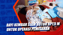 Bayi Kembar Siam Butuh Rp1,5 Miliar untuk Operasi Pemisahan