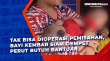 Tak Bisa Dioperasi Pemisahan, Bayi Kembar Siam Dempet Perut Butuh Bantuan