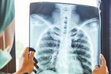 Waspadai Pneumonia pada Lansia, Ingat 4 Langkah Pencegahannya