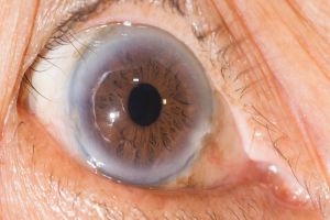 Gejala Kolesterol Tinggi di Mata yang Bisa Sebabkan Kebutaan