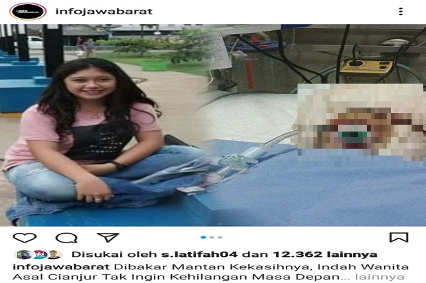 Unggahan Foto Gadis Cantik yang Dibakar Pacarnya Sendiri Gemparkan Cianjur