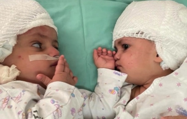 Bayi Kembar Siam di Kepala Sukses Operasi Pemisahan Langka di Israel