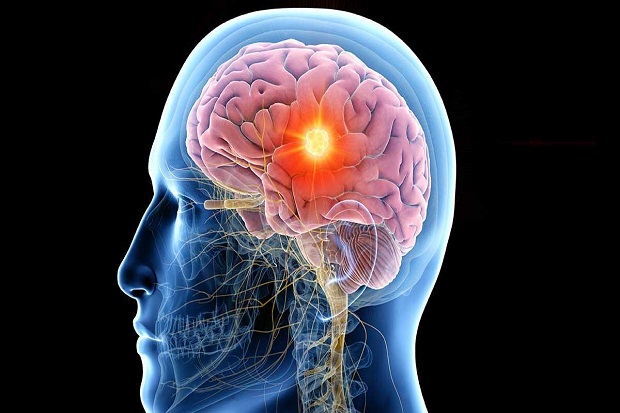 Epilepsi Gangguan Sistem Saraf, Ini Gejala dan Penyebabnya