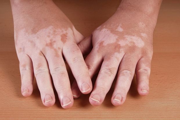 Vitiligo Kebanyakan Muncul di Usia Anak-anak, Ini Saran Dokter untuk Para Orang Tua