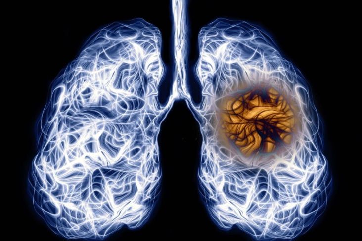 Cara Mencegah Infeksi Paru-paru Secara Efektif, Lakukan Sejak Dini