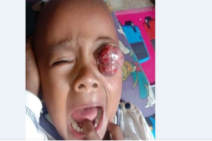 3 Tahun Menderita Tumor Mata, Bocah di Simalungun Meninggal Dunia