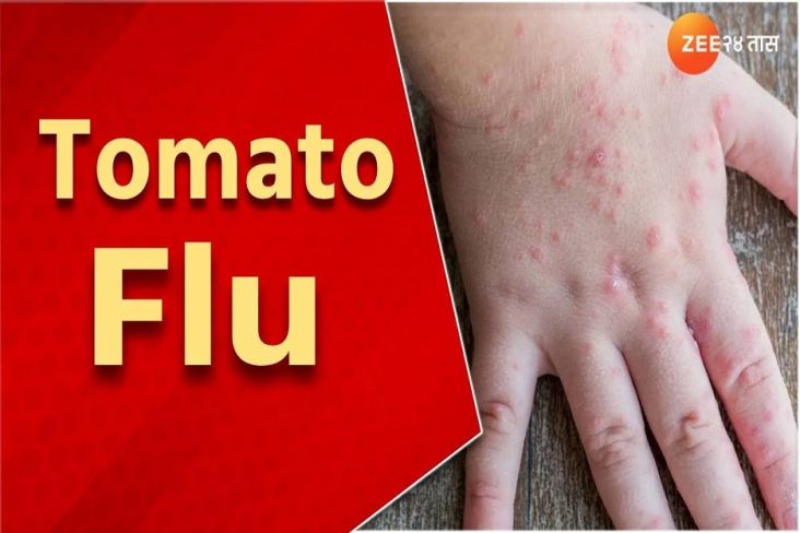 Covid-19 dan Cacar Monyet Belum Hilang, Kini Muncul Flu Tomat