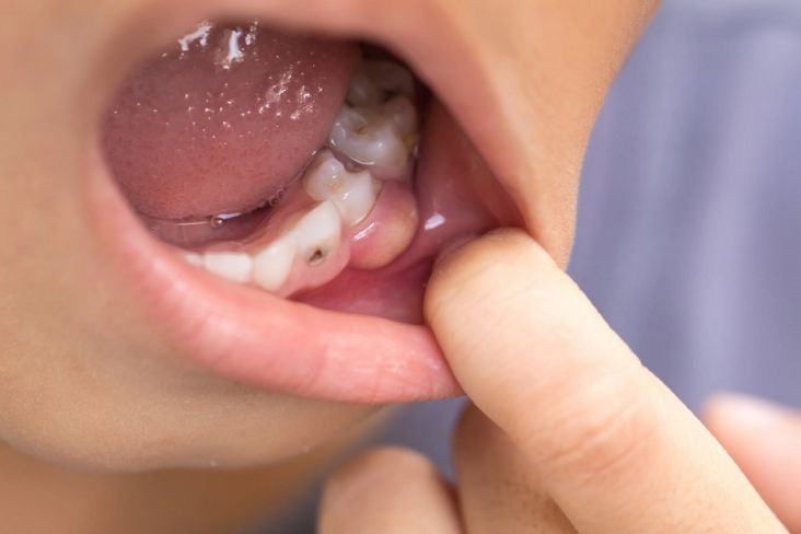 7 Bahaya Gigi Berlubang Jika Terus Dibiarkan, Bisa Kena Stroke