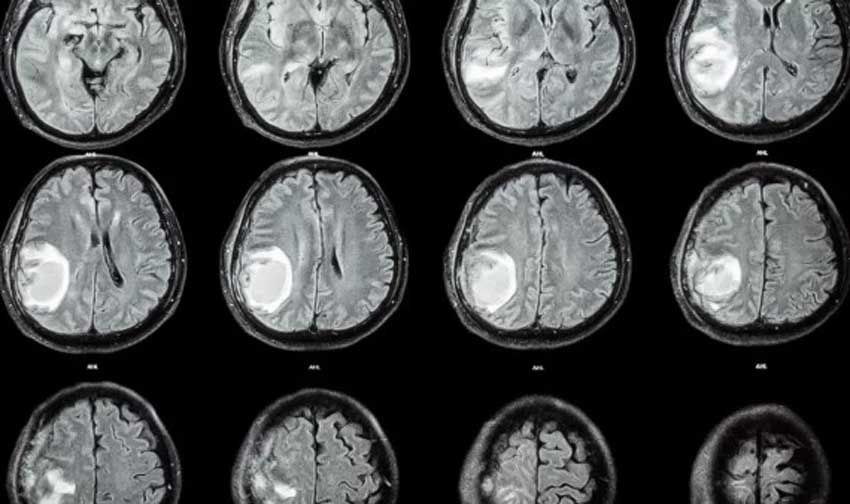 Kasus Langka, Dokter Keluarkan Janin dari Otak Anak Berusia 1 Tahun