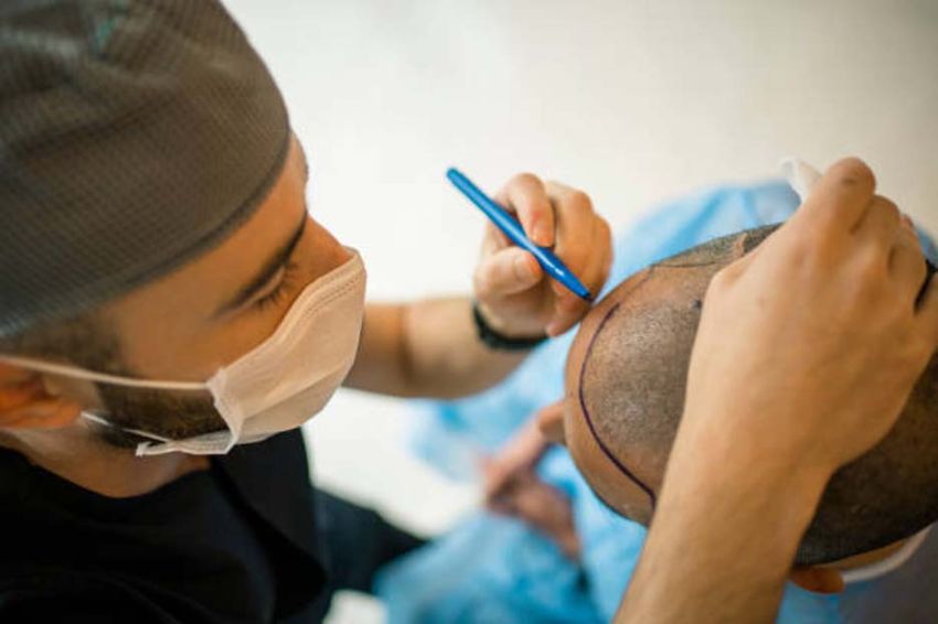 Dilakukan Banyak Selebritas, Apa Manfaat Transplantasi Rambut selain Atasi Kebotakan?
