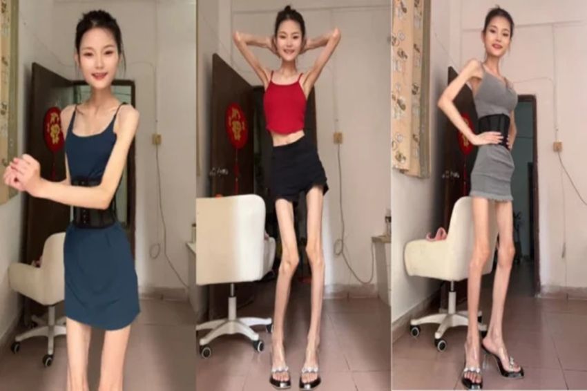 Viral! Wanita Ini Punya Berat Badan 25 Kg, tapi Masih Ingin Kurus Lagi