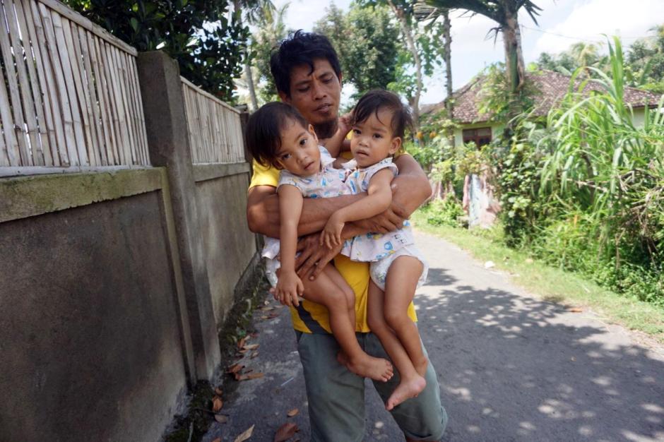 Dua Tahun Menanti, Bayi Kembar Siam Inaya dan Anaya Akan Menjalani Operasi di Surabaya-2