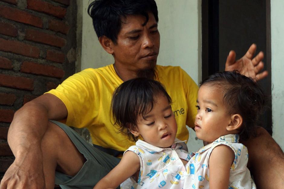 Dua Tahun Menanti, Bayi Kembar Siam Inaya dan Anaya Akan Menjalani Operasi di Surabaya-0