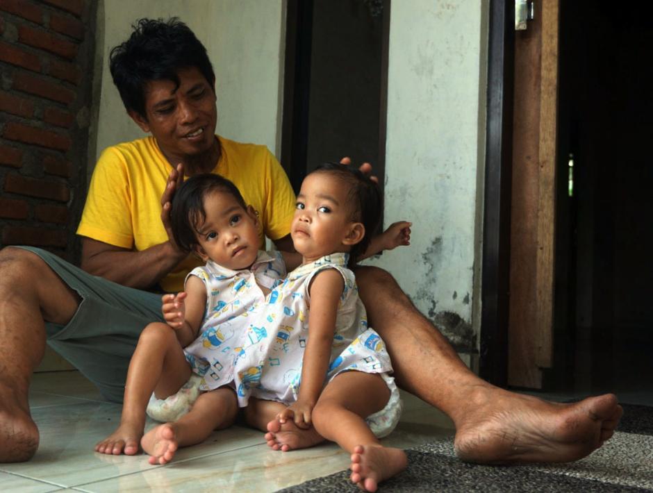 Dua Tahun Menanti, Bayi Kembar Siam Inaya dan Anaya Akan Menjalani Operasi di Surabaya-1