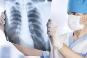 Atasi Penyakit Tuberkulosis, Kemenkes Rencanakan Skrining TBC Besar-besaran Tahun Ini