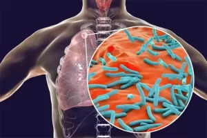Apakah Kuman TB Dapat Menular lewat Air Liur?